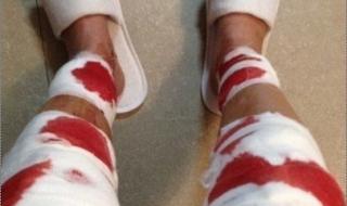 o型腿怎么办 o型腿怎么办